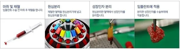 자가혈 잇몸뼈 재생술 단계 일러스트