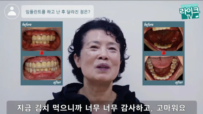 전체 임플란트 후기 영상 후기